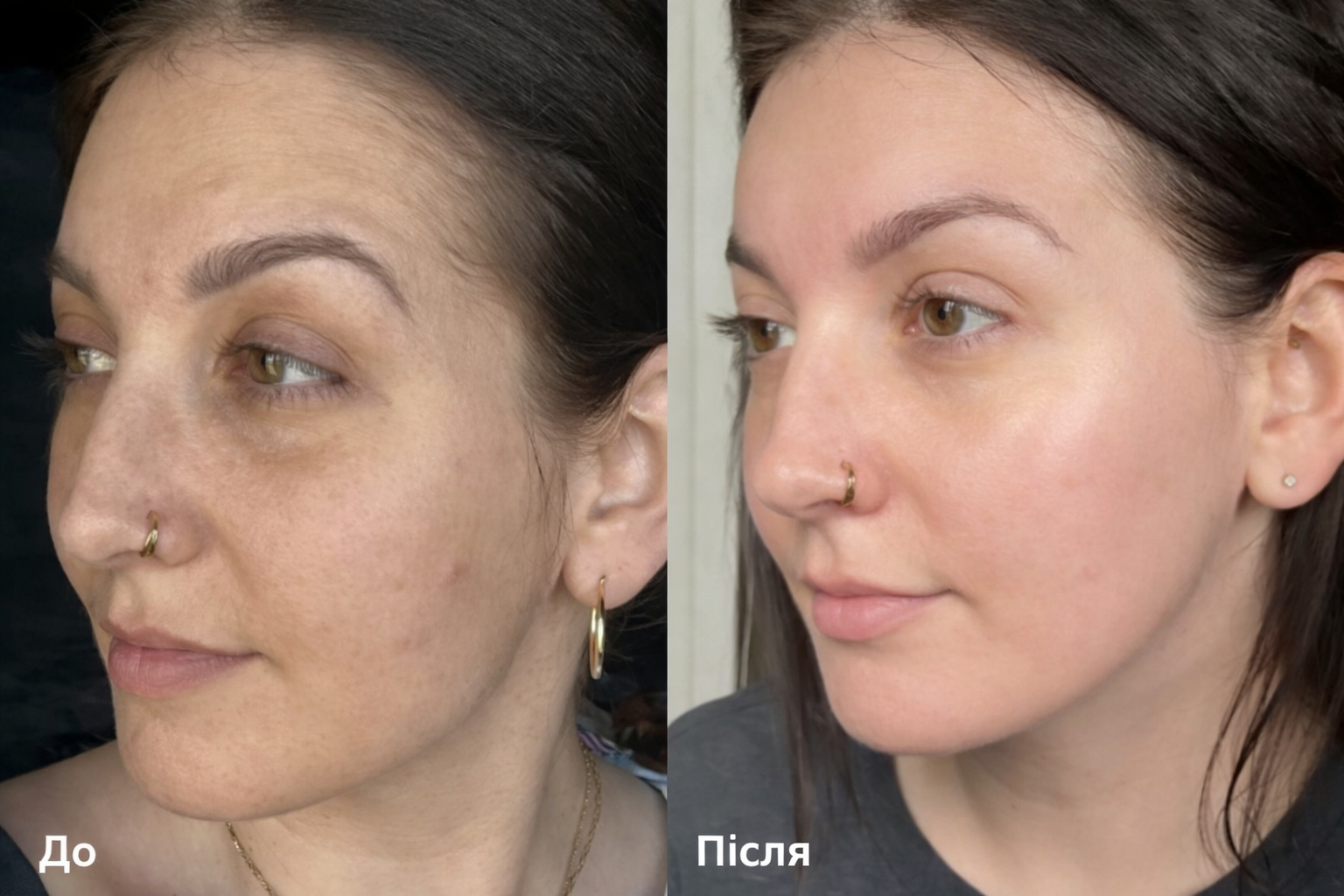 Arbutin 7% + Tranexamic Acid 4% Cream — Освітлюючий крем для шкіри обличчя