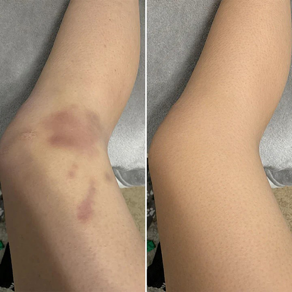 Крем для відновлення синців і зміцнення шкіри Limetow Bruise Cream