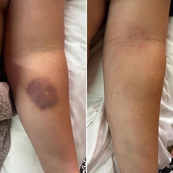 Крем для відновлення синців і зміцнення шкіри Limetow Bruise Cream