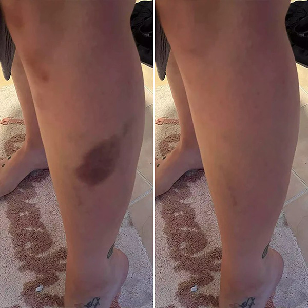Крем для відновлення синців і зміцнення шкіри Limetow Bruise Cream